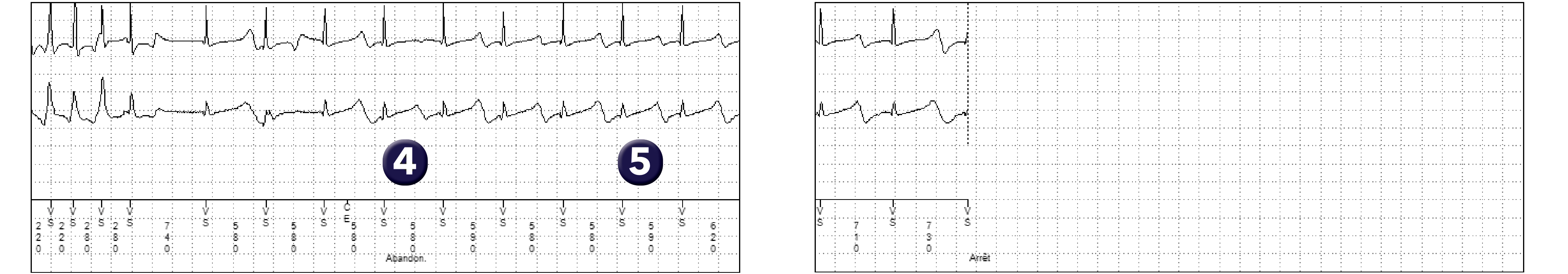 Électrogramme Medtronic DAI, segment 2 sur 2 — Réduction des thérapies évitables par allongement des compteurs