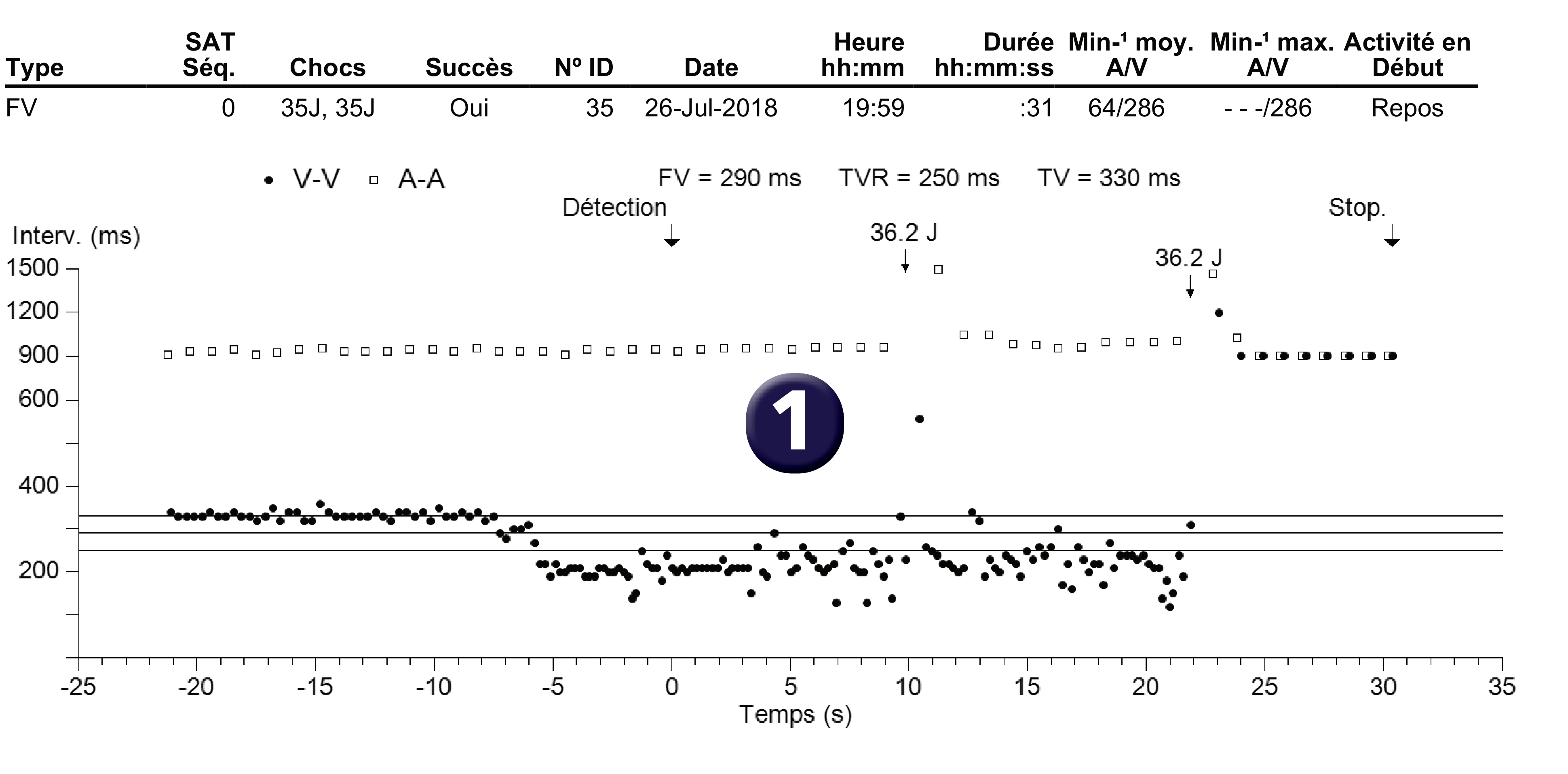 Électrogramme Medtronic DAI, segment 1 sur 1 — Compteur initial et compteur de redétection