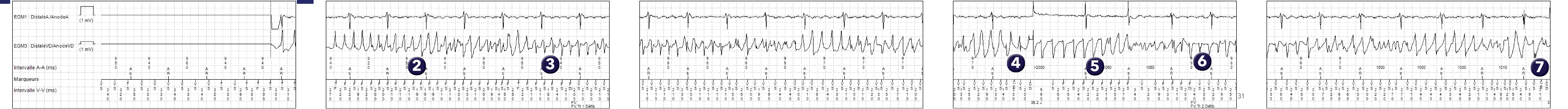 Électrogramme Medtronic DAI, segment 1 sur 2 — Compteur initial et compteur de redétection