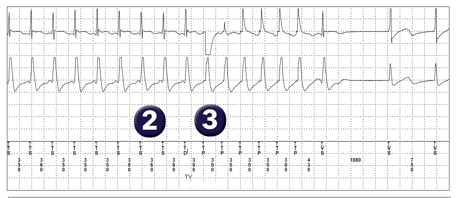 Électrogramme Medtronic DAI, segment 1 sur 1 — Spécificités du compteur de TV