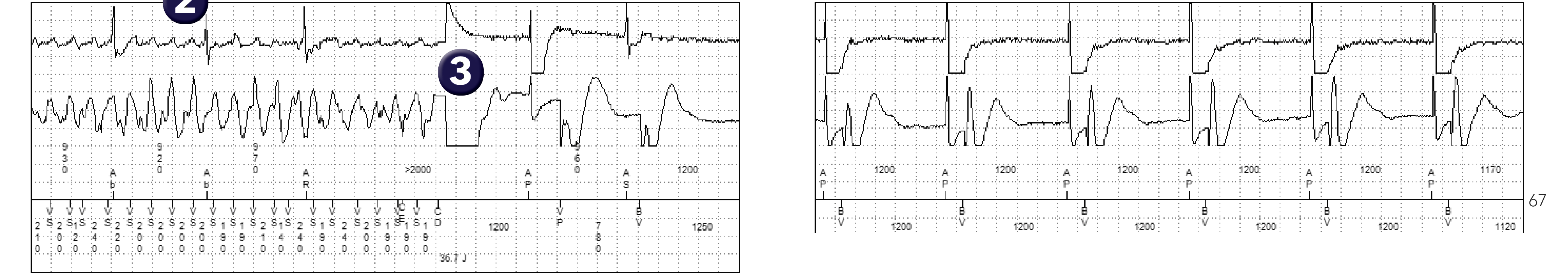 Électrogramme Medtronic DAI, segment 2 sur 2 — Un choc électrique pour restaurer un rythme viable