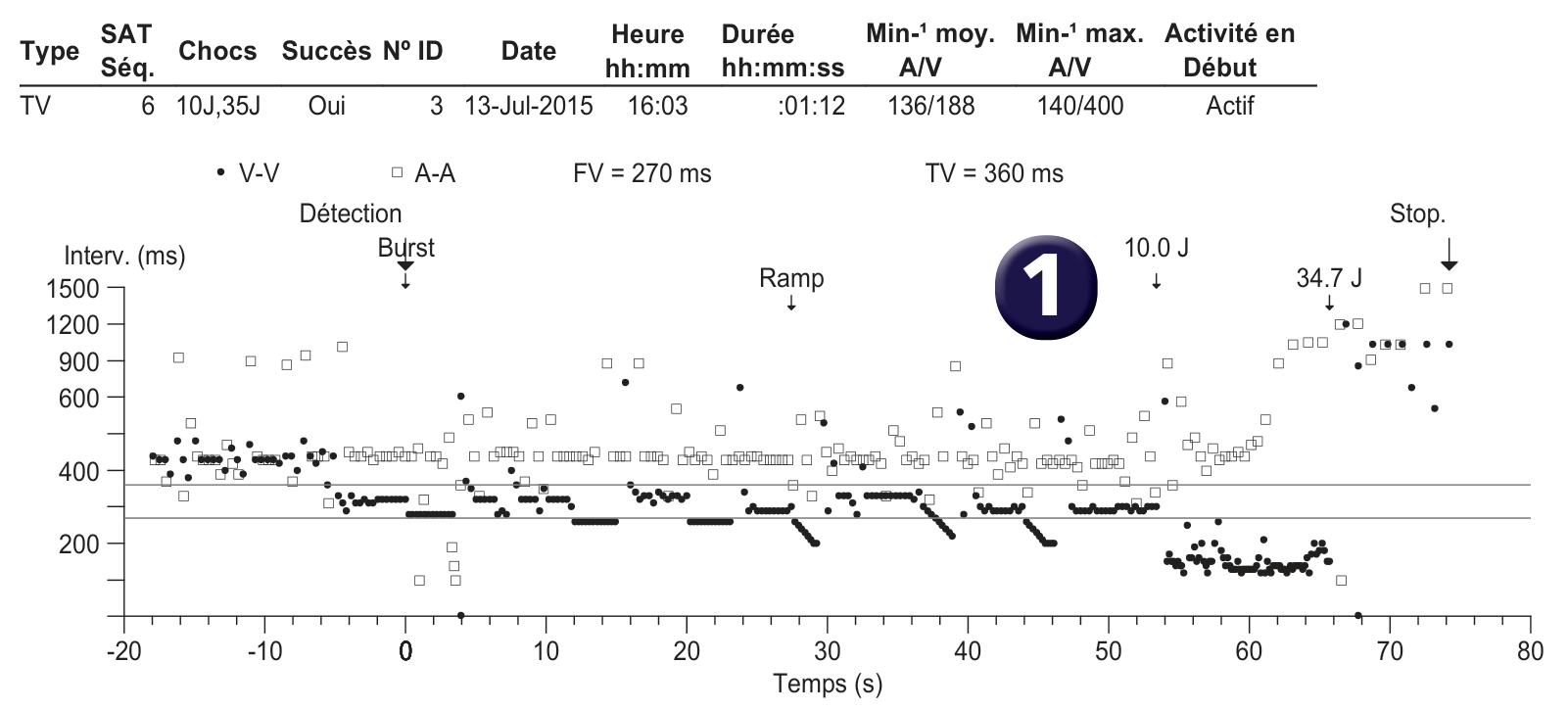 Électrogramme Medtronic DAI, segment 1 sur 1 — Effet pro-arythmogène d’un choc électrique de faible amplitude