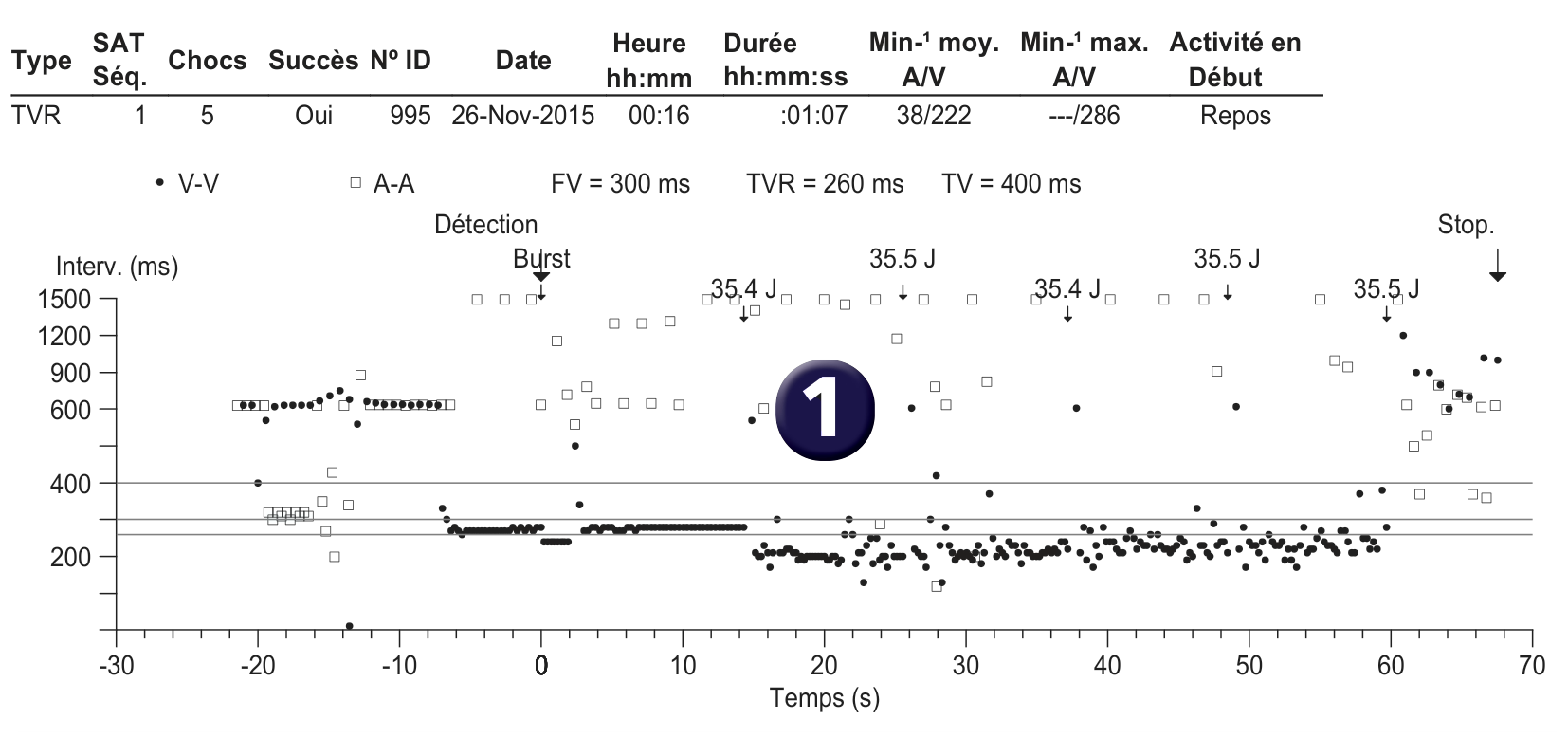 Électrogramme Medtronic DAI, segment 1 sur 1 — Seuil de défibrillation et limite supérieure de vulnérabilité
