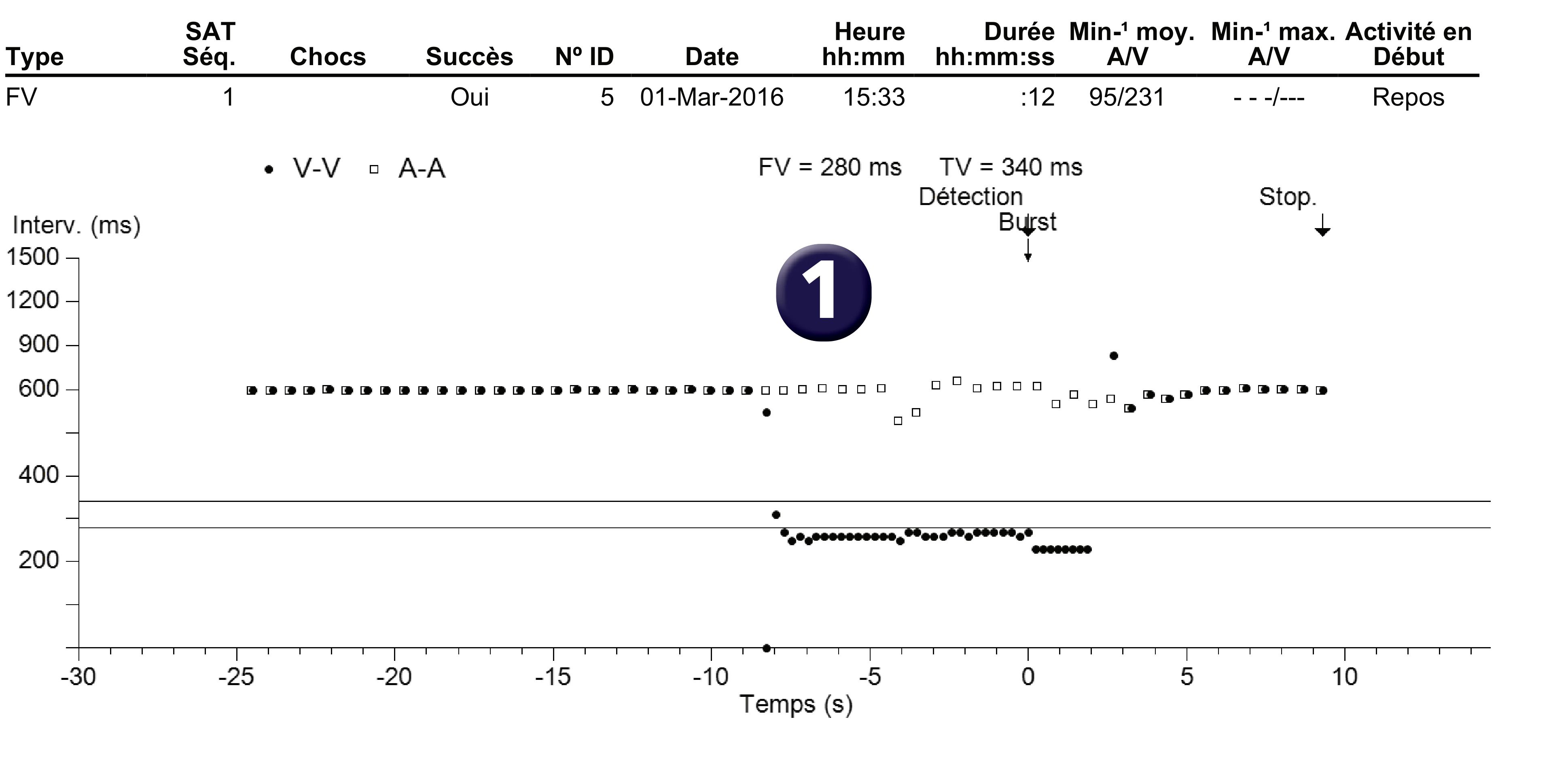 Électrogramme Medtronic DAI, segment 1 sur 1 — Stimulation anti-tachycardique en zone de FV