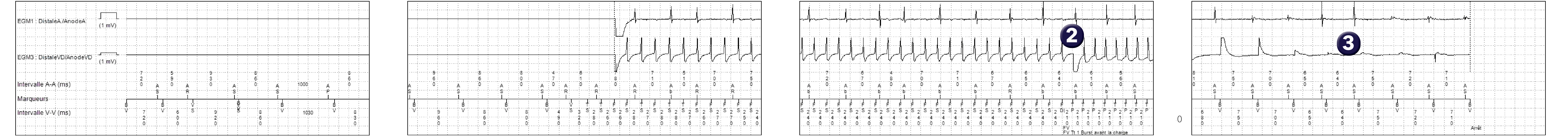 Électrogramme Medtronic DAI, segment 1 sur 1 — Stimulation anti-tachycardique en zone de FV et économie d’énergie