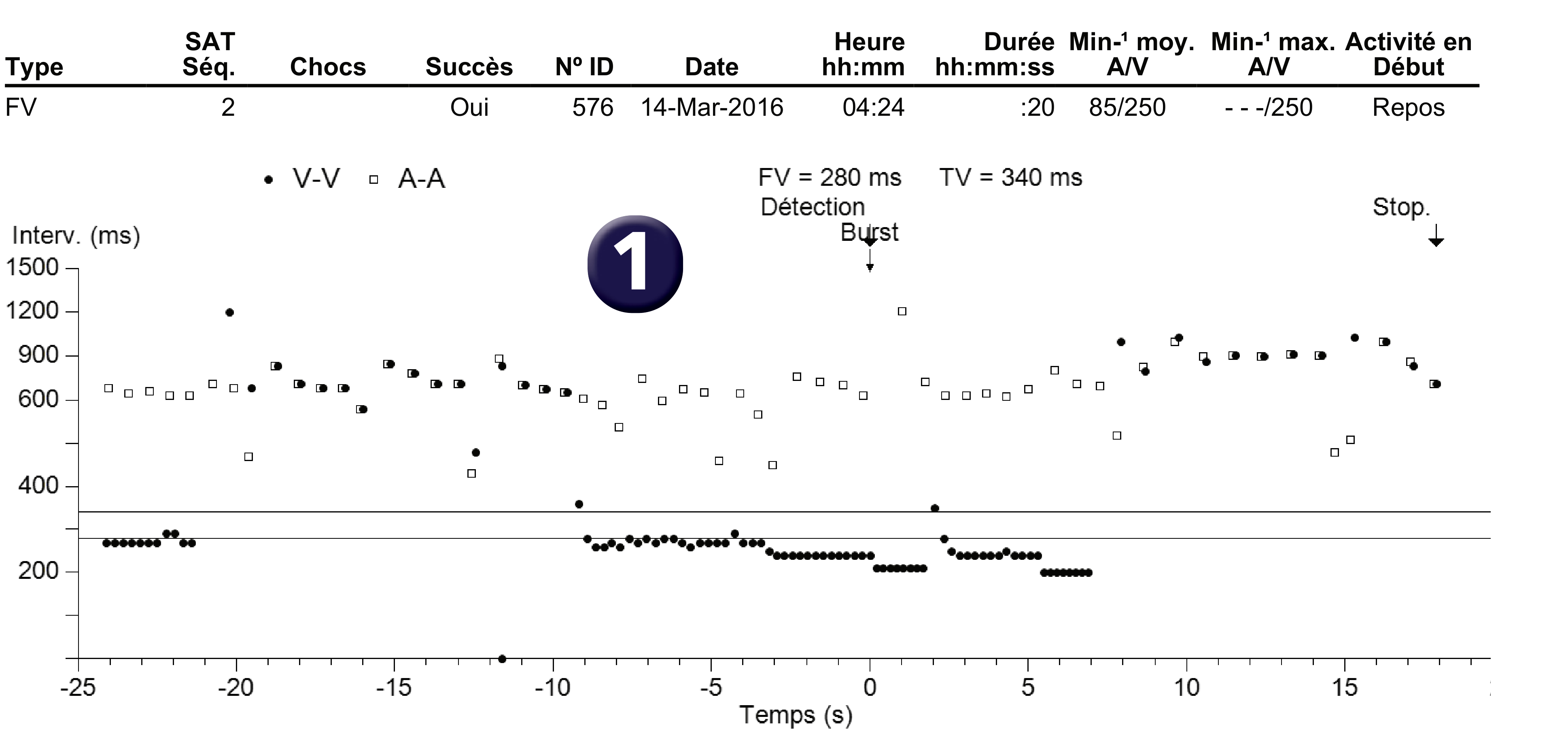 Électrogramme Medtronic DAI, segment 1 sur 1 — Double séquence de stimulation anti-tachycardique