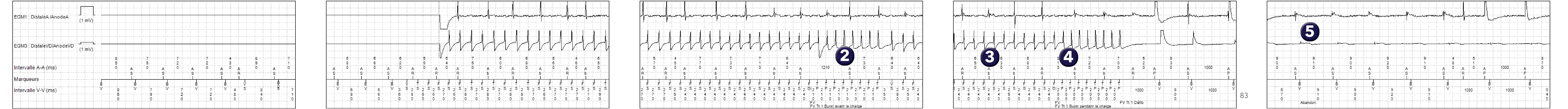 Électrogramme Medtronic DAI, segment 1 sur 1 — Double séquence de stimulation anti-tachycardique