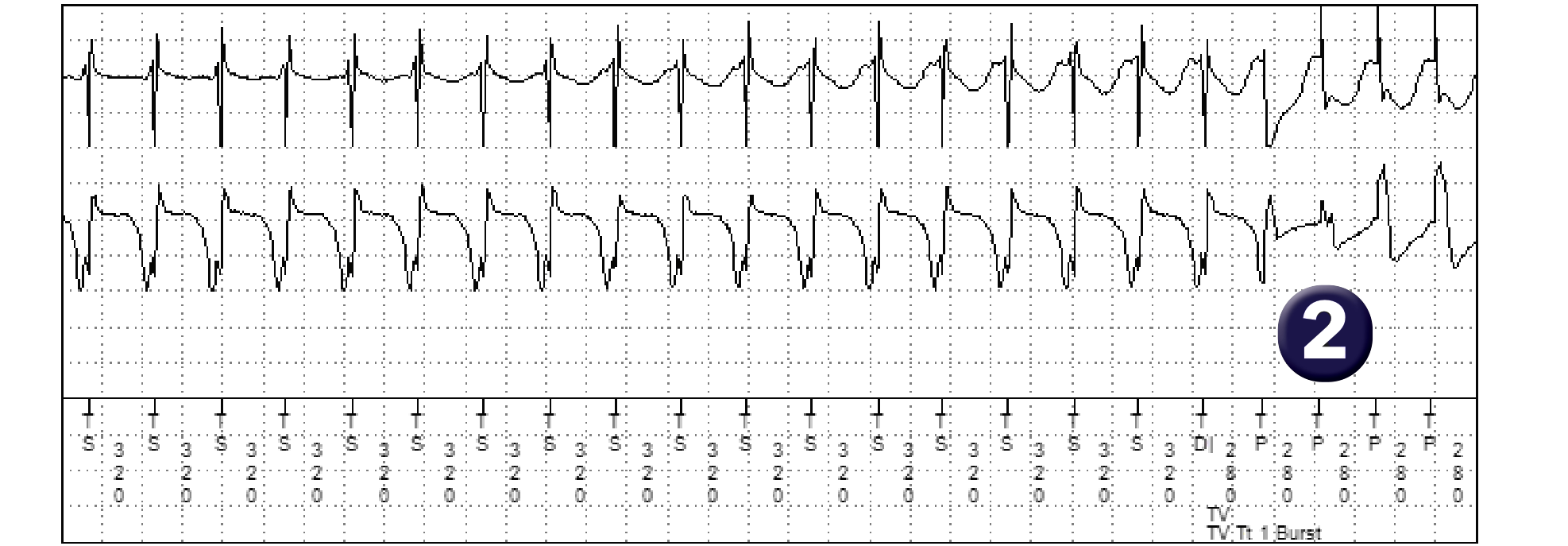 Électrogramme Medtronic DAI, segment 2 sur 2 — Bursts ou rampes ?