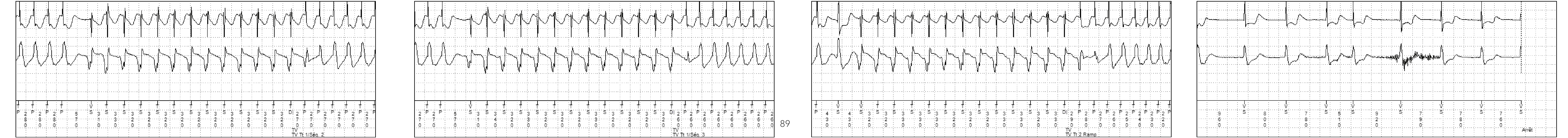 Électrogramme Medtronic DAI, segment 2 sur 2 — Bursts ou rampes ?