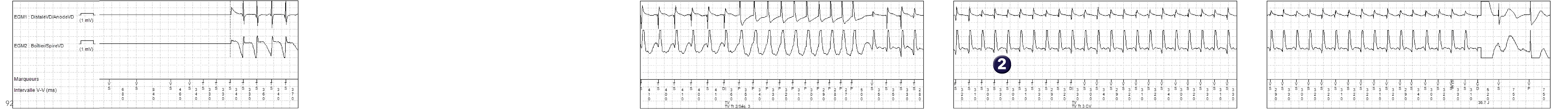 Électrogramme Medtronic DAI, segment 1 sur 3 — Accélération après plusieurs séquences de stimulation anti-tachycardique