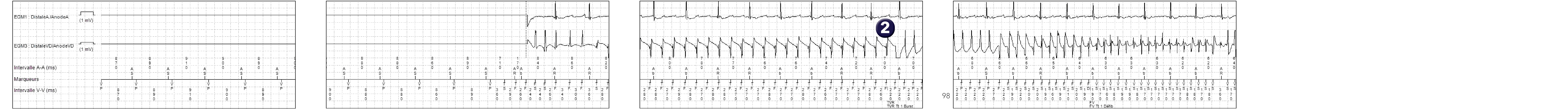 Électrogramme Medtronic DAI, segment 1 sur 2 — Accélération après stimulation anti-tachycardique