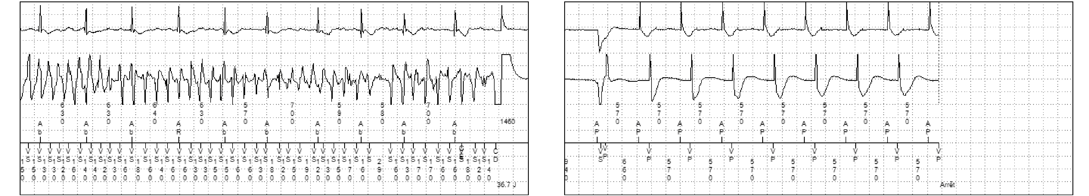 Électrogramme Medtronic DAI, segment 2 sur 2 — Accélération après stimulation anti-tachycardique