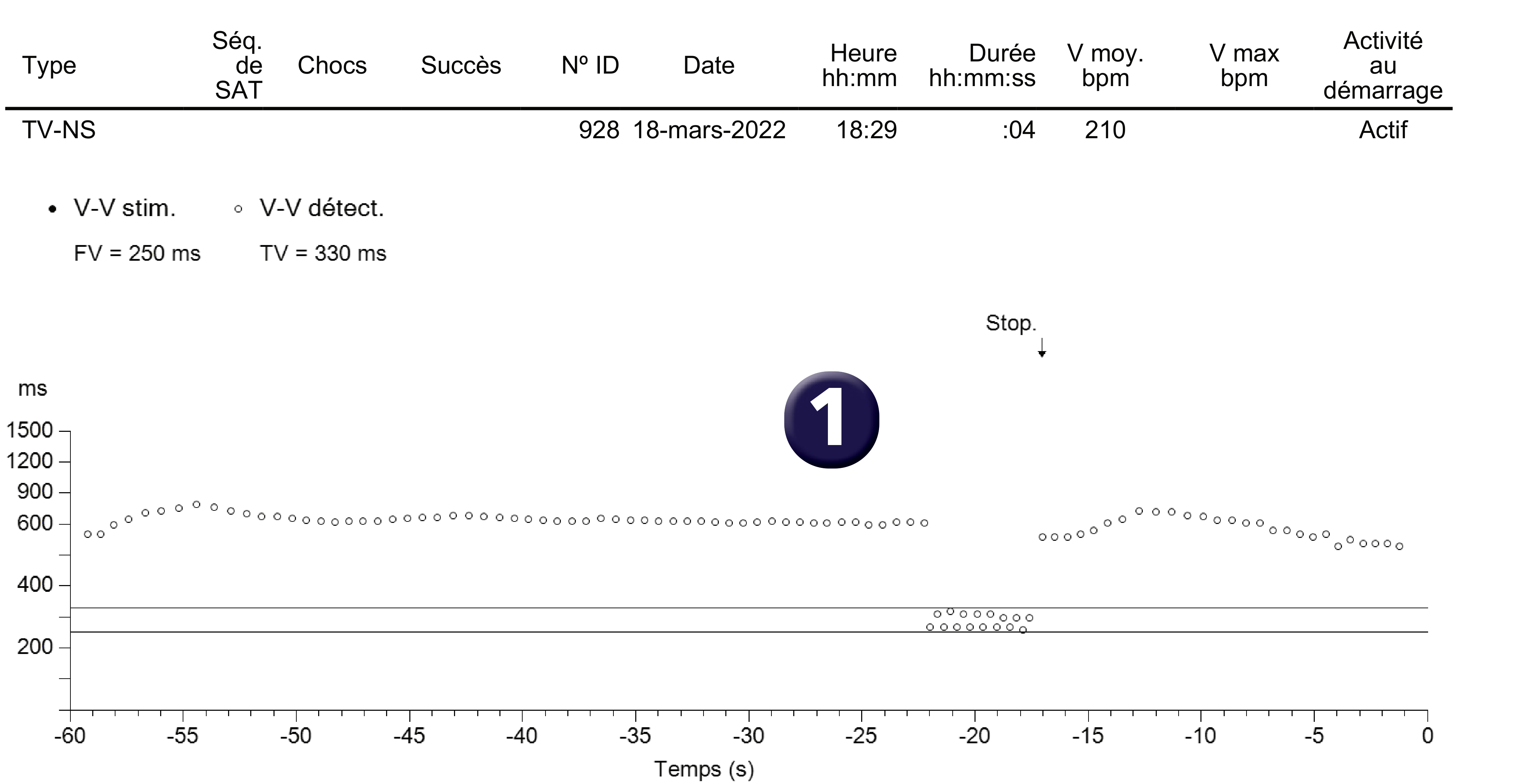 Électrogramme Medtronic DAI, segment 1 sur 2 — Un aspect de graphe particulier