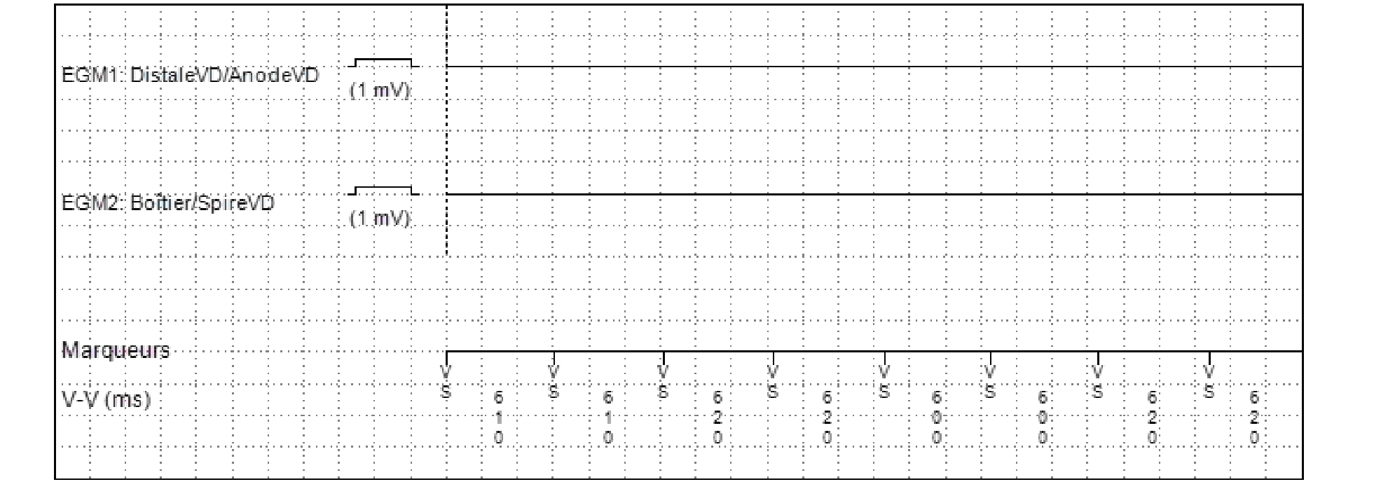 Électrogramme Medtronic DAI, segment 1 sur 2 — Un aspect de graphe particulier