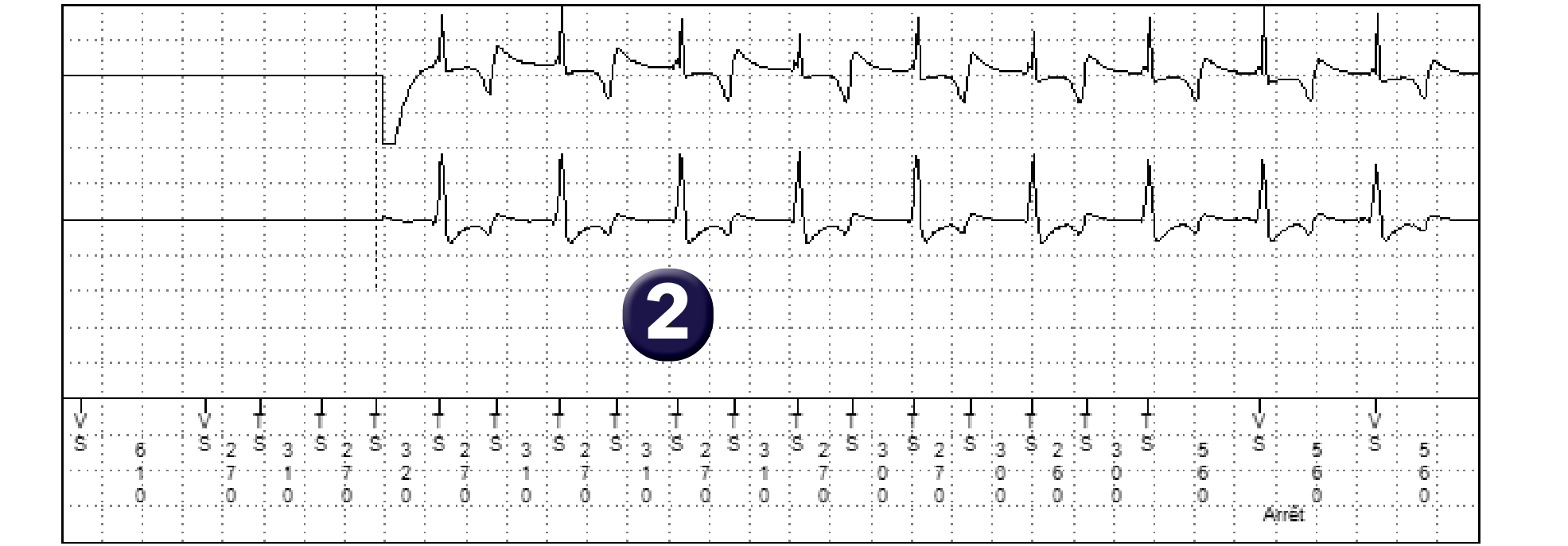 Électrogramme Medtronic DAI, segment 2 sur 2 — Un aspect de graphe particulier