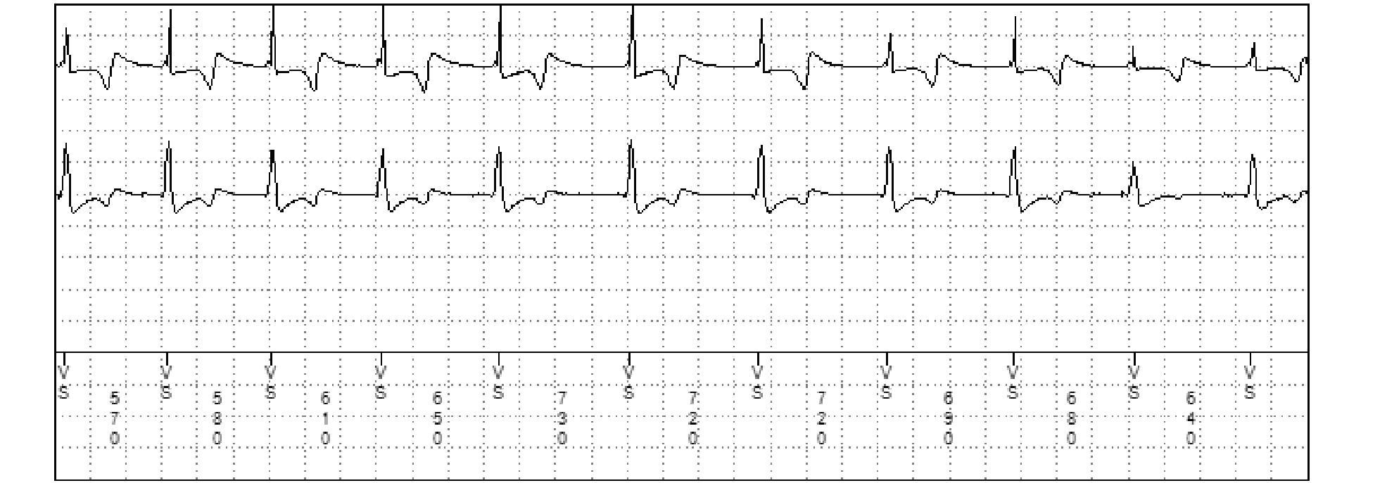 Électrogramme Medtronic DAI, segment 2 sur 2 — Un aspect de graphe particulier