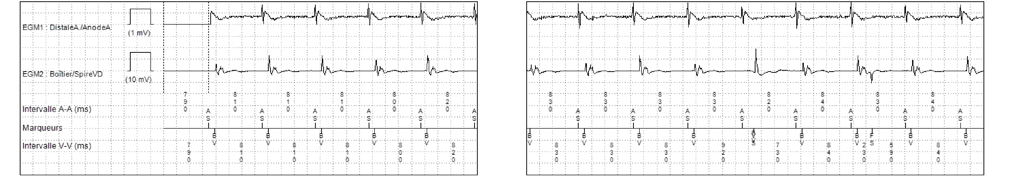 Électrogramme Medtronic DAI, segment 1 sur 2 — Des cycles ventriculaires trop courts pour être physiologiques