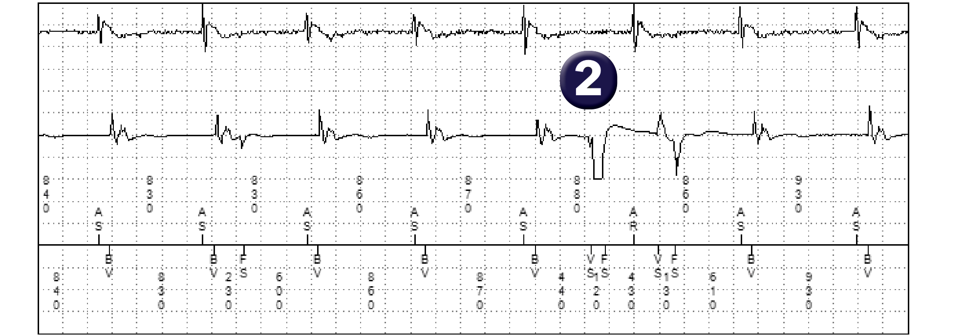 Électrogramme Medtronic DAI, segment 2 sur 2 — Des cycles ventriculaires trop courts pour être physiologiques