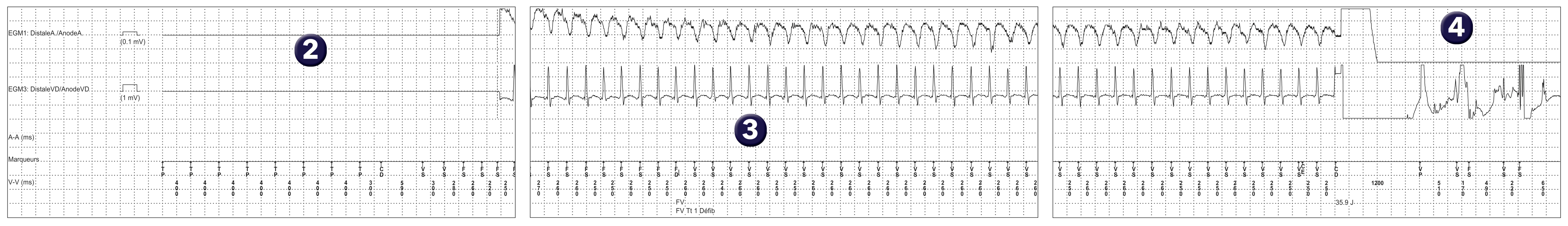 Électrogramme Medtronic DAI, segment 1 sur 1 — Intérêt d’une induction en fin d’implantation