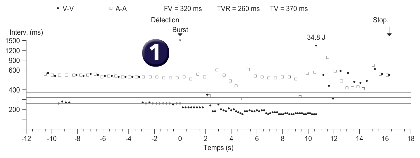 Électrogramme Medtronic DAI, segment 1 sur 4 — Surdétection et risque de mort subite