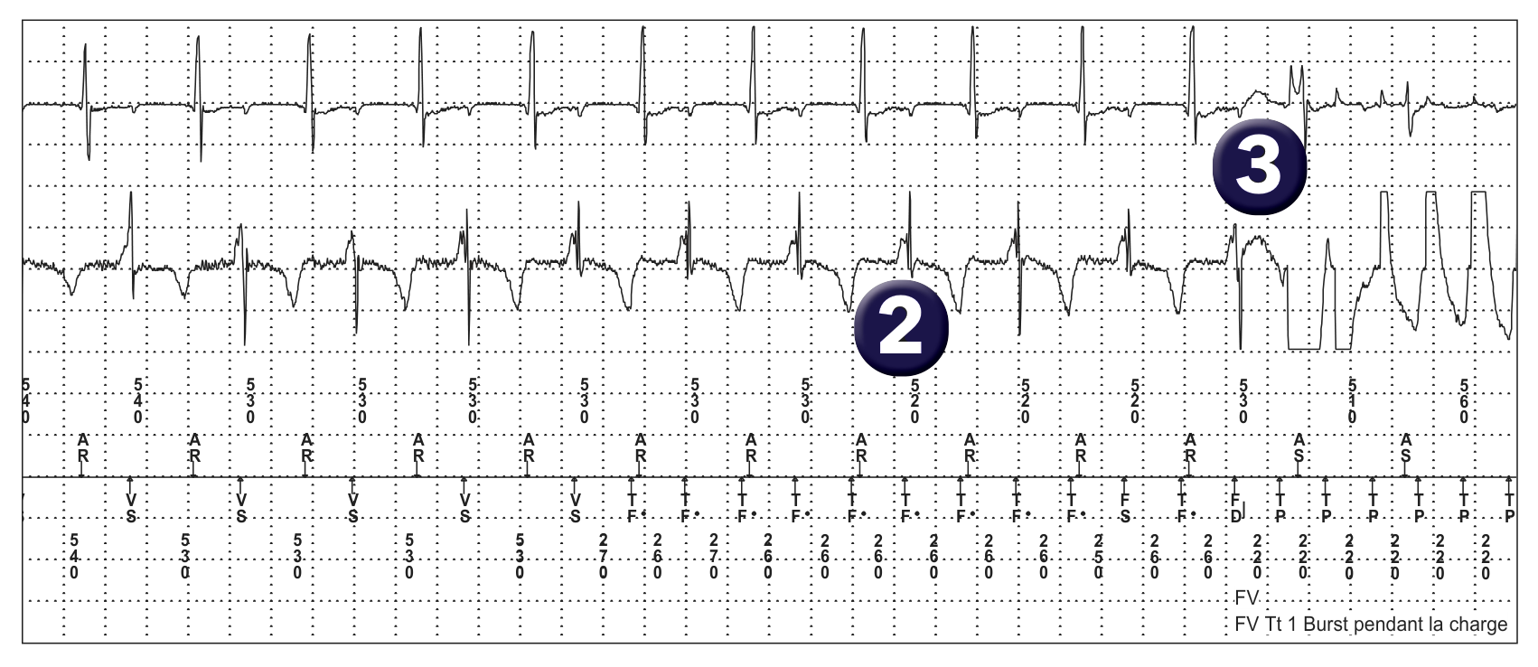Électrogramme Medtronic DAI, segment 2 sur 4 — Surdétection et risque de mort subite