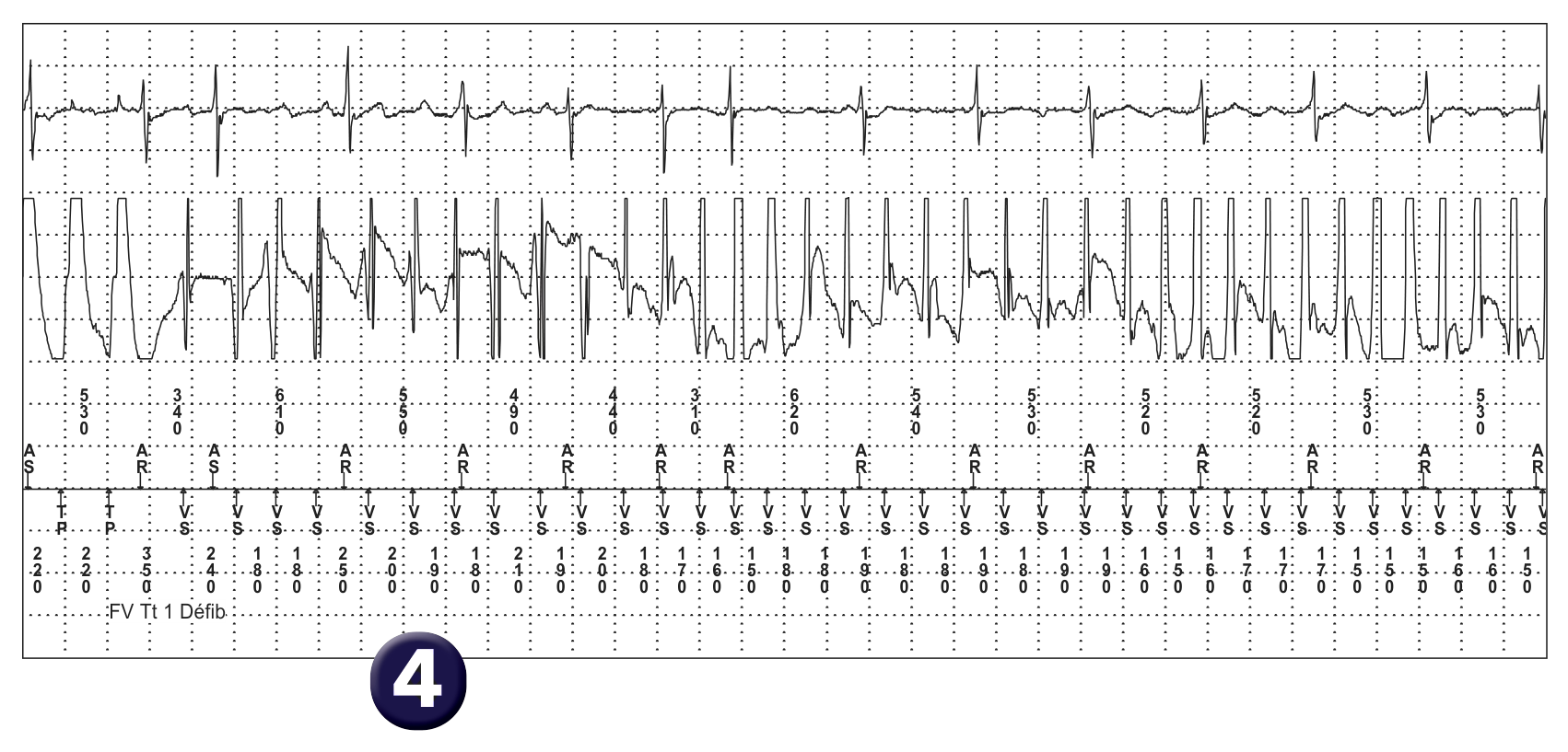 Électrogramme Medtronic DAI, segment 3 sur 4 — Surdétection et risque de mort subite