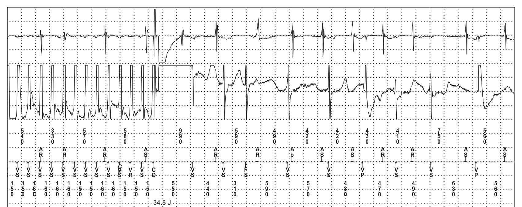 Électrogramme Medtronic DAI, segment 4 sur 4 — Surdétection et risque de mort subite