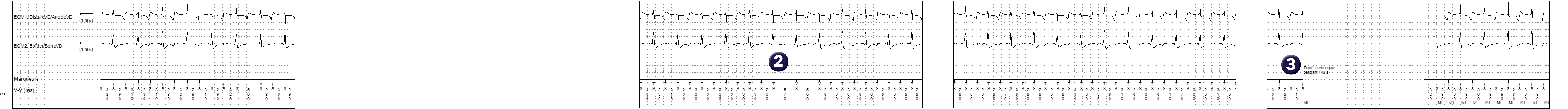 Électrogramme Medtronic DAI, segment 1 sur 2 — Intervention d’un algorithme inattendu