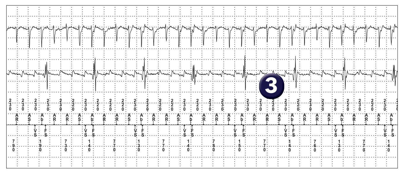 Électrogramme Medtronic DAI, segment 1 sur 1 — Surdétection et sonde bipolaire intégrée