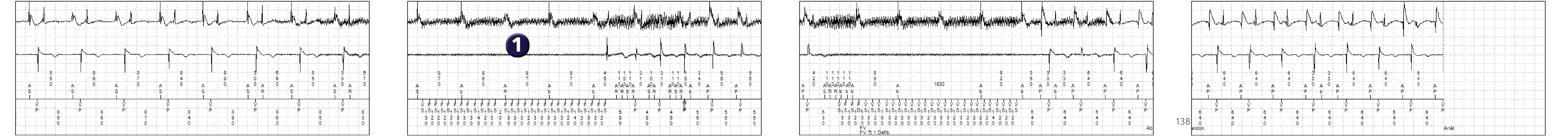 Électrogramme Medtronic DAI, segment 1 sur 2 — Une cause inattendue de syncope