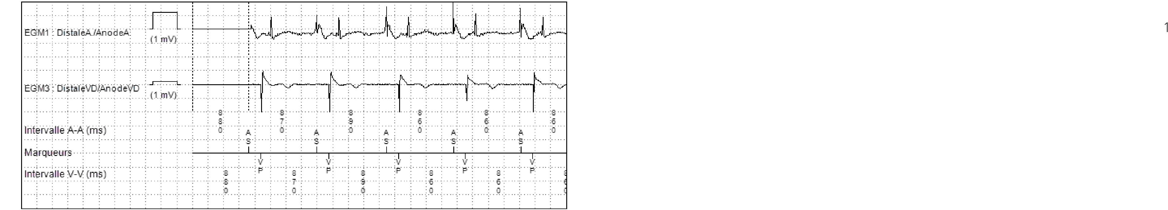 Électrogramme Medtronic DAI, segment 2 sur 2 — Une cause inattendue de syncope