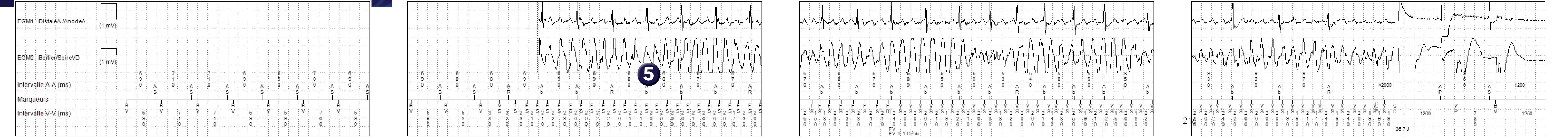 Électrogramme Medtronic DAI, segment 1 sur 1 — Défibrillateur triple chambre et limite V. TSV