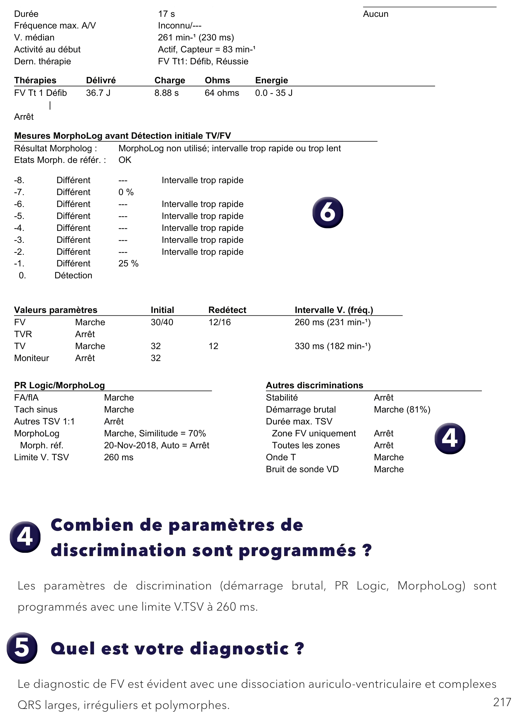 Électrogramme Medtronic DAI, segment 1 sur 1 — Défibrillateur triple chambre et limite V. TSV