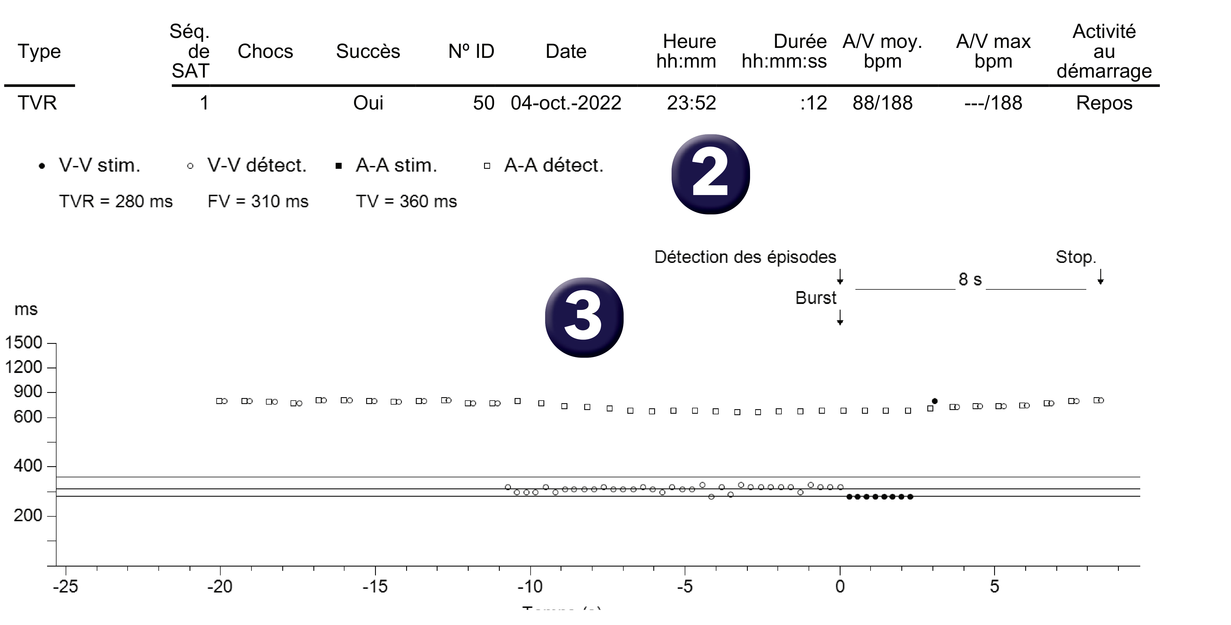 Électrogramme Medtronic DAI, segment 1 sur 1 — Défibrillateur double chambre et dissociation auriculo-ventriculaire