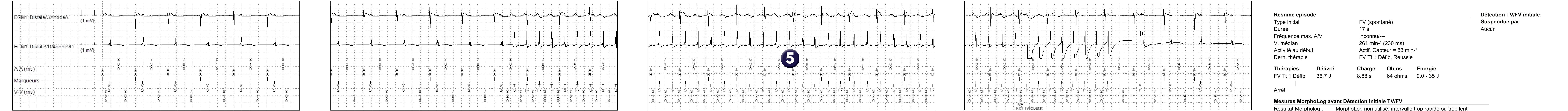 Électrogramme Medtronic DAI, segment 1 sur 1 — Défibrillateur double chambre et dissociation auriculo-ventriculaire