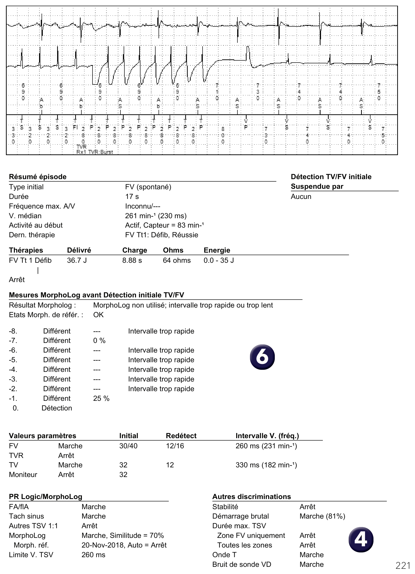 Électrogramme Medtronic DAI, segment 1 sur 1 — Défibrillateur double chambre et dissociation auriculo-ventriculaire