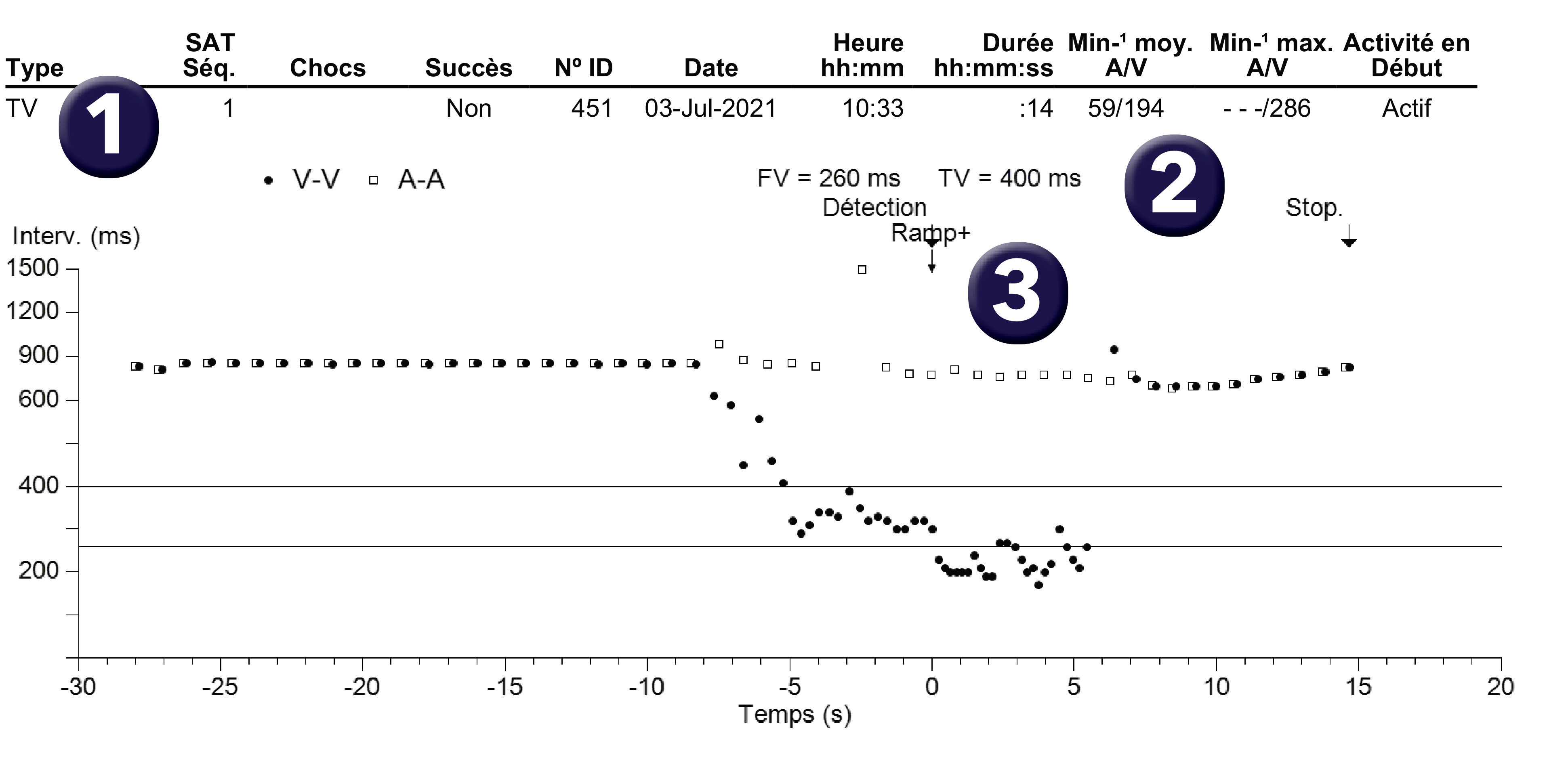 Électrogramme Medtronic DAI, segment 1 sur 1 — PR Logic versus MorphoLog