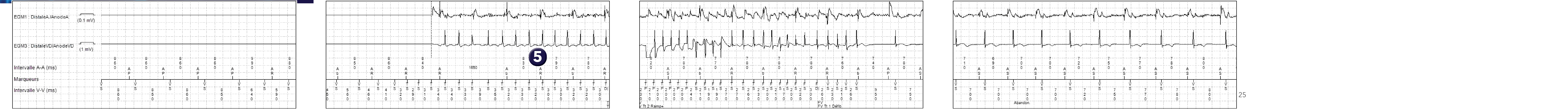 Électrogramme Medtronic DAI, segment 1 sur 1 — PR Logic versus MorphoLog
