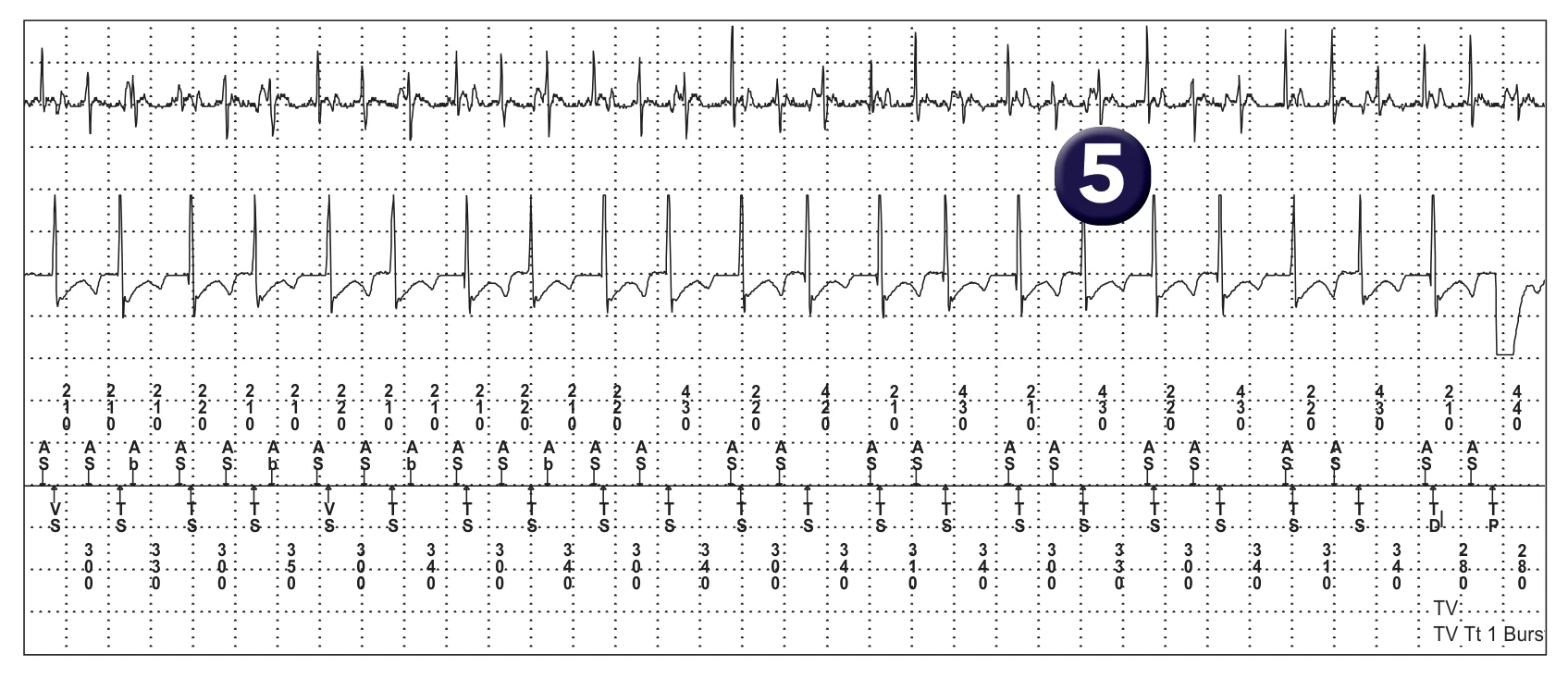 Électrogramme Medtronic DAI, segment 3 sur 6 — Discrimination double chambre et détection atriale