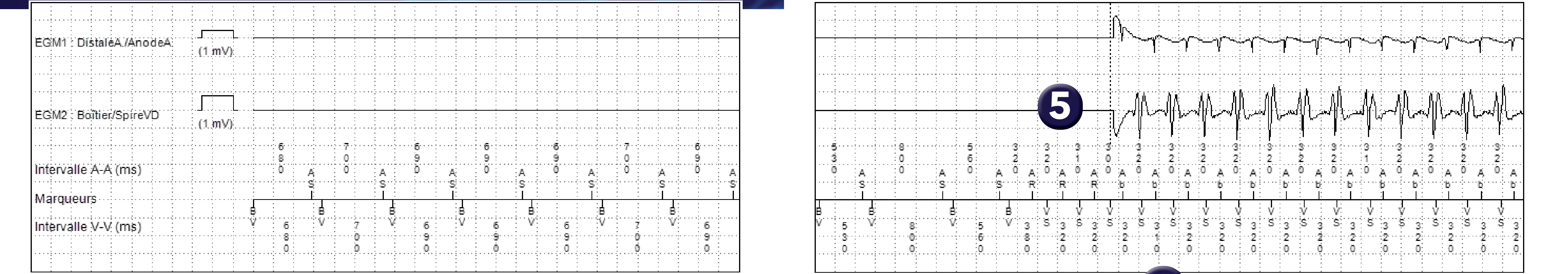Électrogramme Medtronic DAI, segment 1 sur 2 — Tachycardie 1/1, PR Logic, MorphoLog