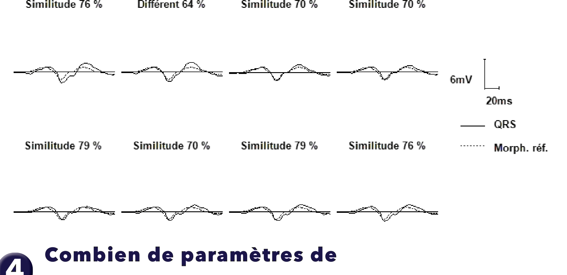 Électrogramme Medtronic DAI, segment 1 sur 1 — Tachycardie 1/1, PR Logic, MorphoLog