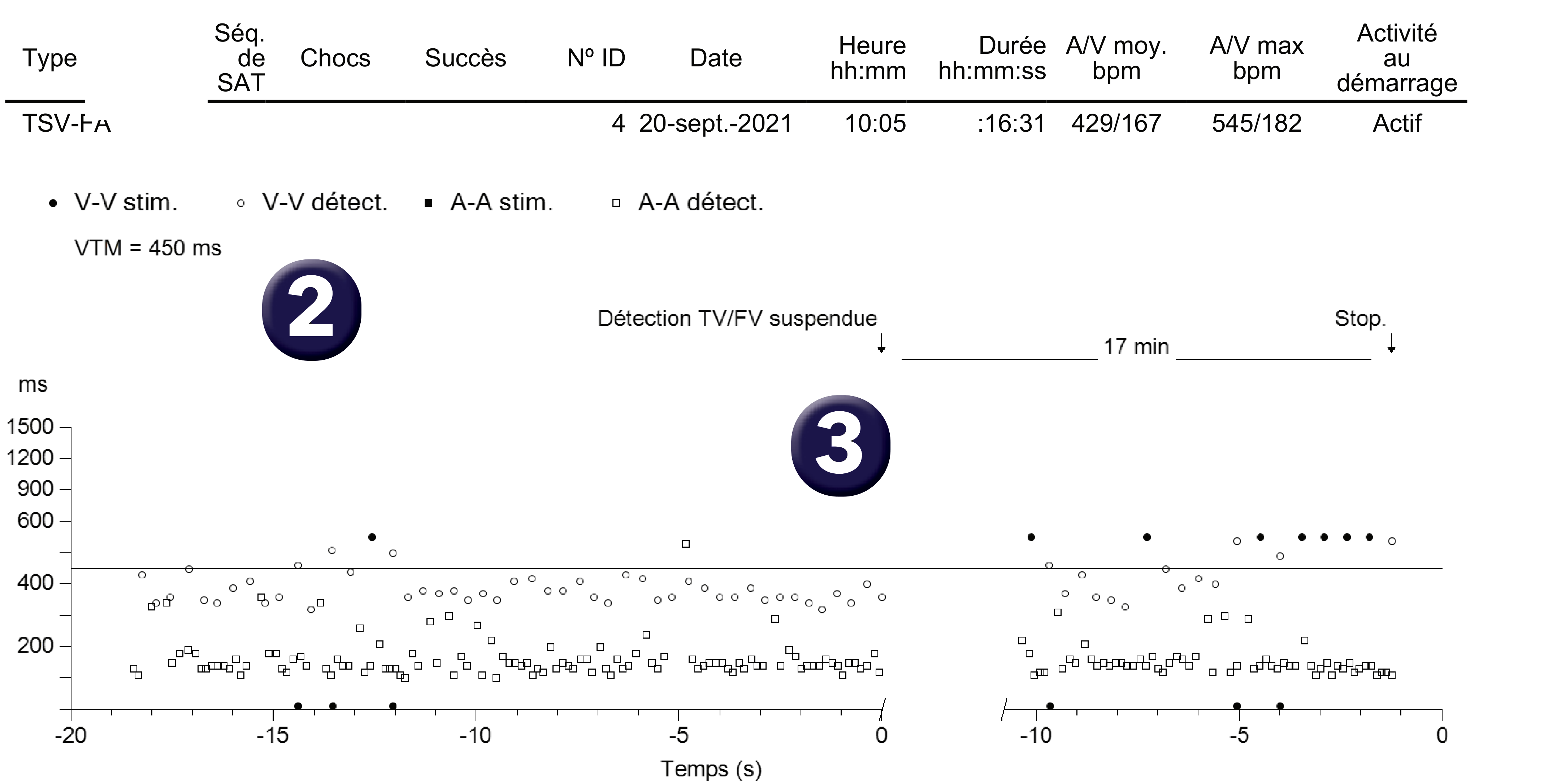 Électrogramme Medtronic DAI, segment 1 sur 3 — PR Logic et FA conduite