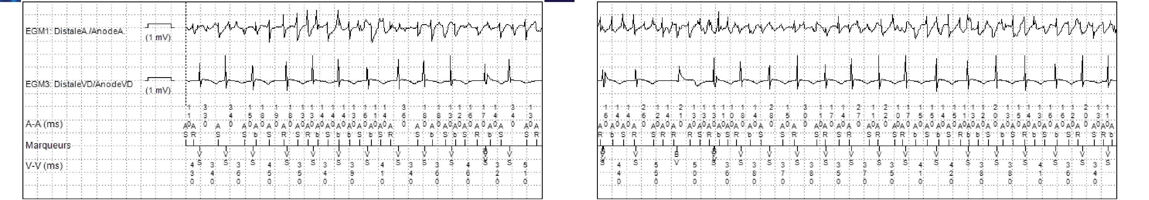 Électrogramme Medtronic DAI, segment 1 sur 3 — PR Logic et FA conduite