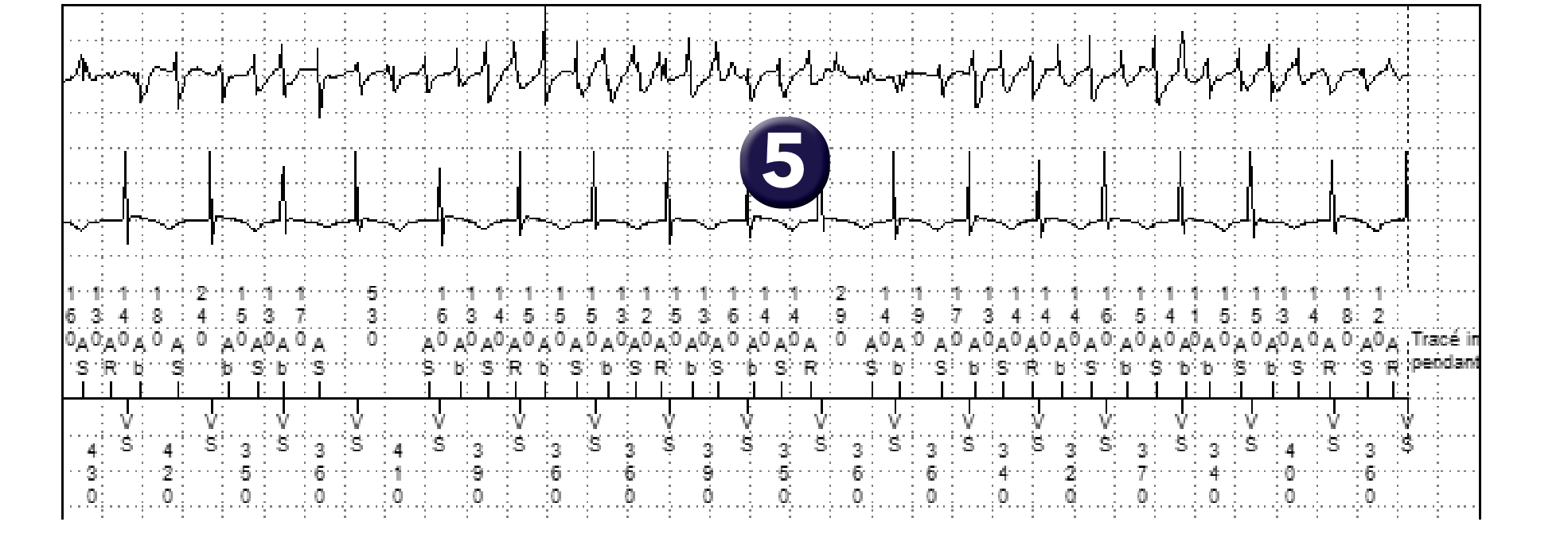 Électrogramme Medtronic DAI, segment 2 sur 3 — PR Logic et FA conduite