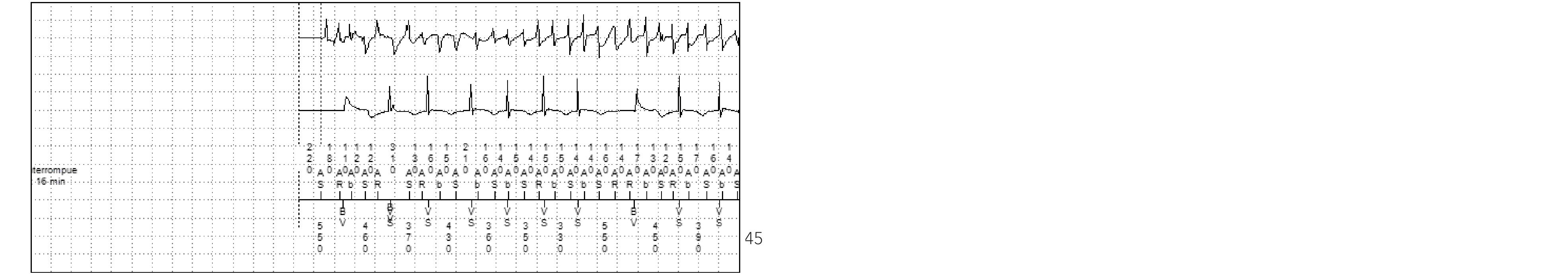 Électrogramme Medtronic DAI, segment 2 sur 3 — PR Logic et FA conduite
