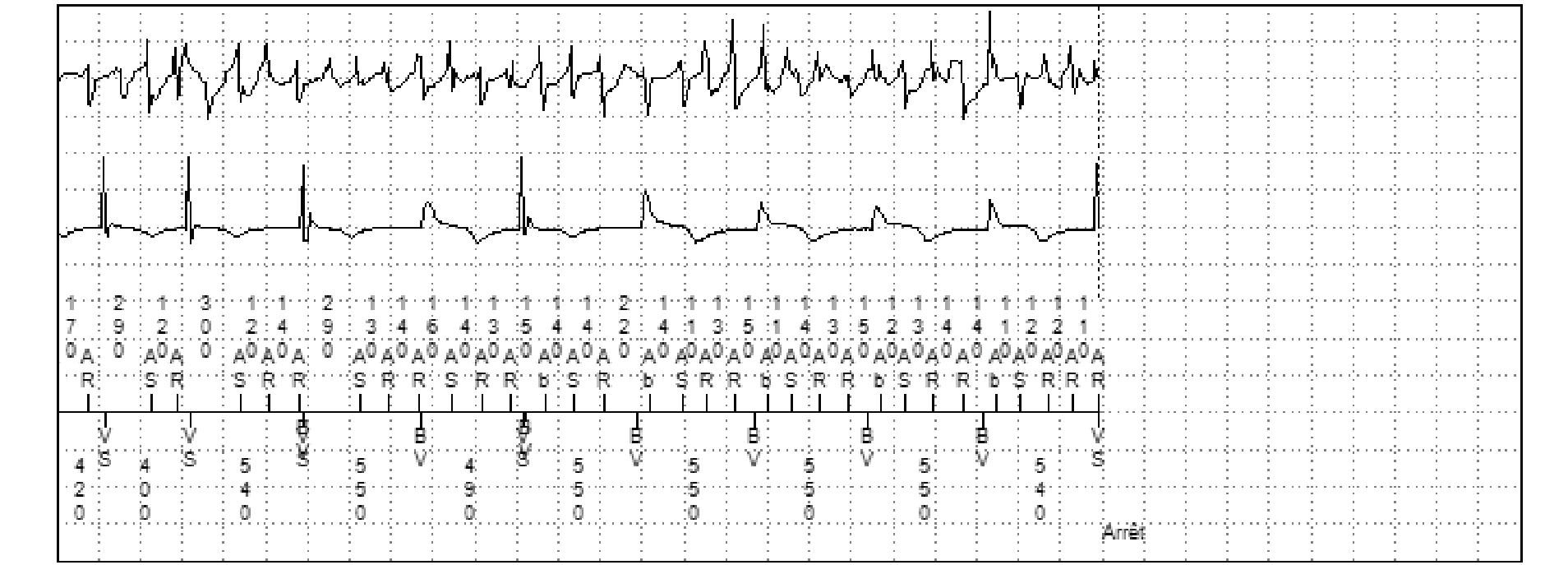 Électrogramme Medtronic DAI, segment 3 sur 3 — PR Logic et FA conduite