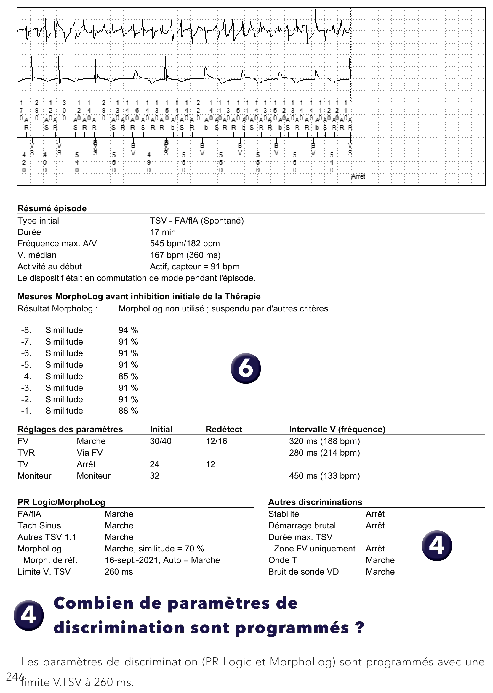 Électrogramme Medtronic DAI, segment 1 sur 1 — PR Logic et FA conduite