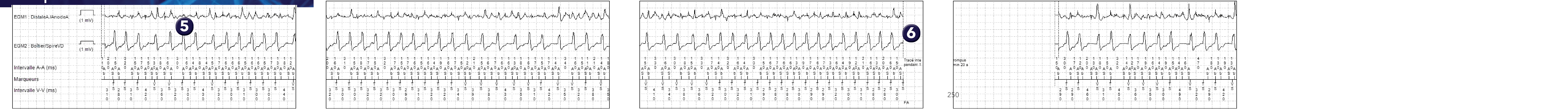Électrogramme Medtronic DAI, segment 1 sur 2 — FA conduite, PR Logic et MorphoLog