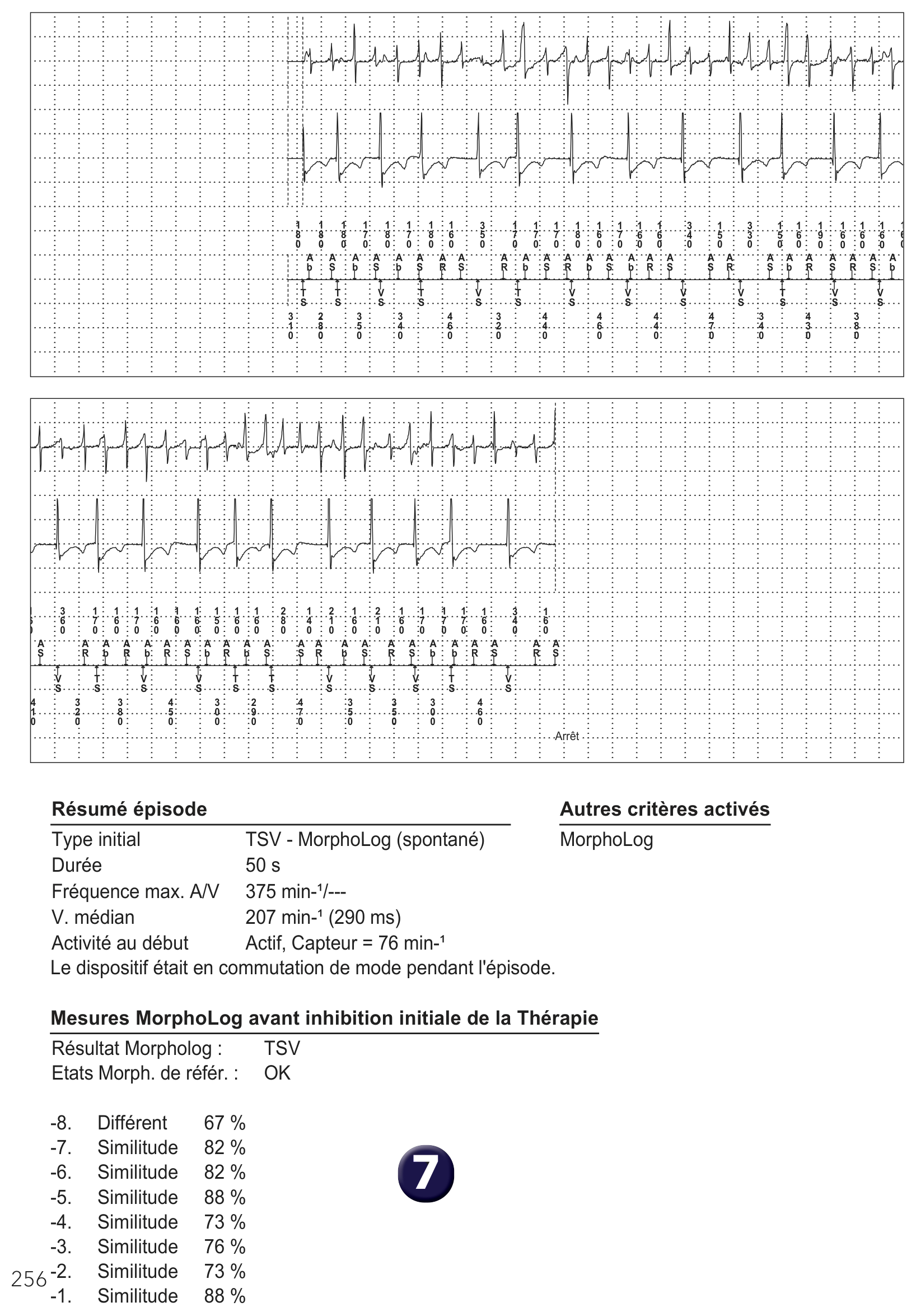 Électrogramme Medtronic DAI, segment 1 sur 2 — FA régularisée, PR Logic et MorphoLog
