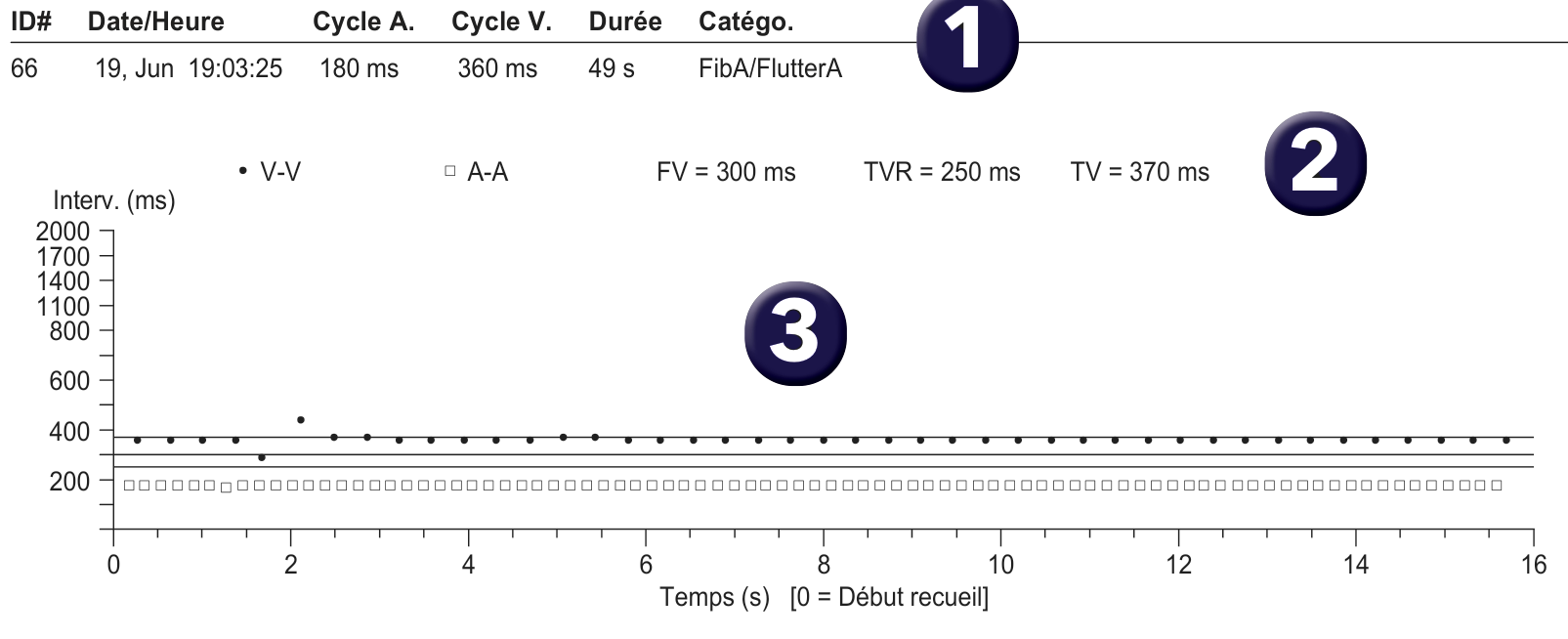 Électrogramme Medtronic DAI, segment 1 sur 1 — PR Logic et flutter atrial